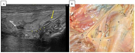 Anatomical Relationships of the Proximal Attachment of the Hamstring ...