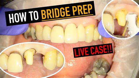 Homemade Dental Bridge 的图像结果