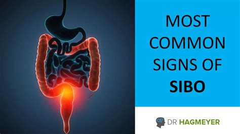 Most common signs of sibo | PPT
