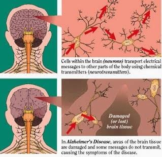 Alzheimer's disease ~ Nursing Path