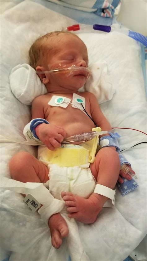 Dax's birth story (32 week preemie, pre-eclamptic birth, xpost to ...