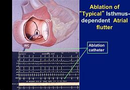 Image result for Atrial