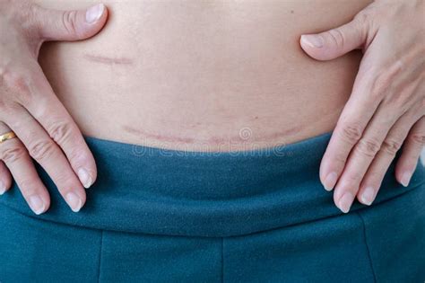 Image result for Appendix Surgery Scar