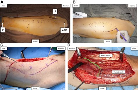 The Anterolateral Thigh Flap in Head and Neck Reconstruction - Oral and ...