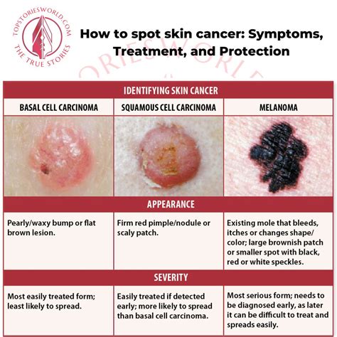 Spot Skin Cancer