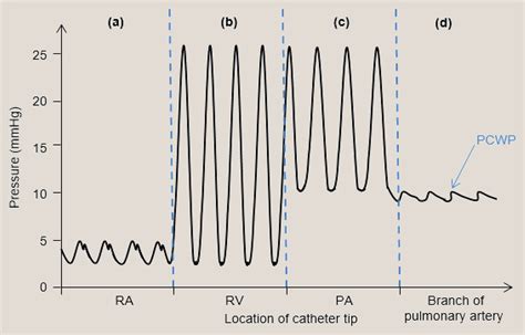 Central venous and pulmonary artery catheters - Anaesthesia & Intensive ...