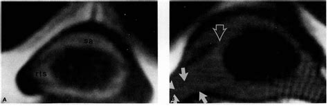 Figure 1 from Birth-related upper brachial plexus injuries in infants ...