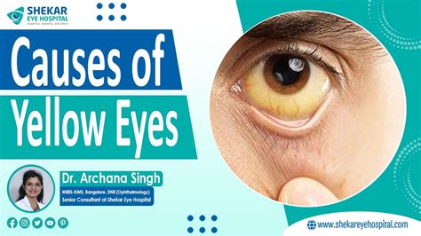 Causes of Yellow Eyes | Yellow Eyes Treatment in Bangalore | Shekar Eye ...