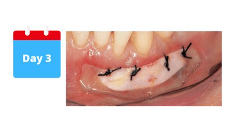 My Gum Graft is Turning White as It Heals, Reasons Week by Week
