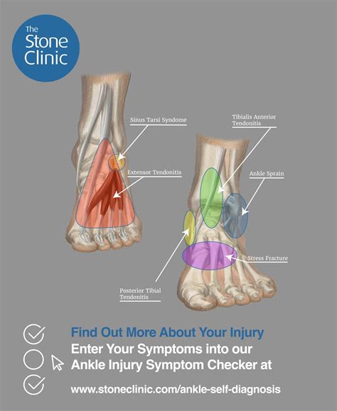 Anatomy Of Ankle Sprain Ankle Sprains