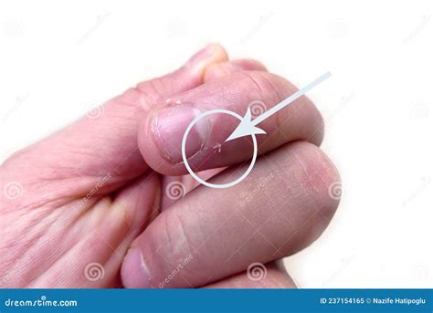 Skin Around Nails Peeling