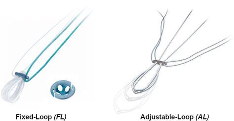 Image result for Transnasal Loop Fixation