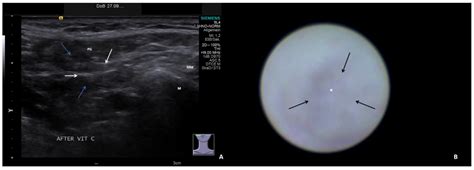 Ultrasound and Sialendoscopy Findings in Radioactive Iodine–Induced ...