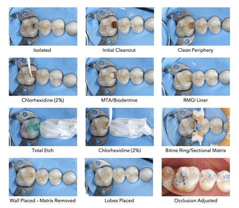 Image result for Direct Pulp Capping Vs RCT