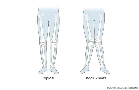Knock Knees Disease