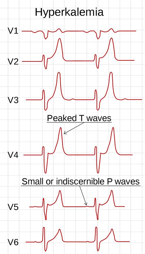 Potassium Level Ecg Changes
