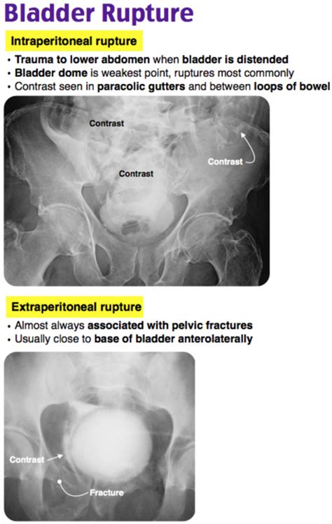 Image result for Bladder Explode