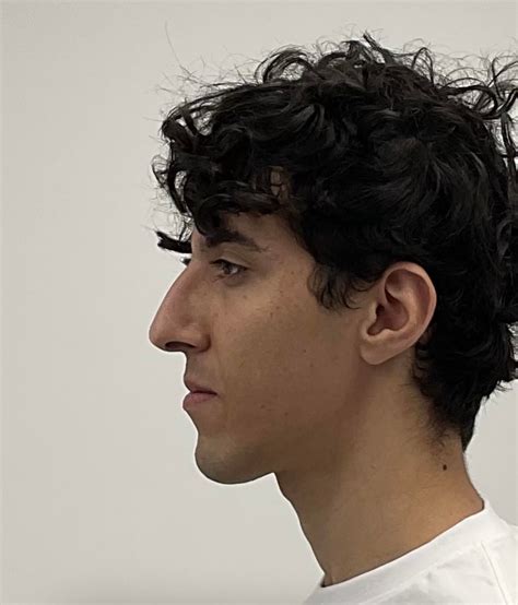 double jaw surgery ccw rotation for “long face syndrome” : u/nyanlong