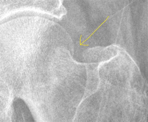 Impacted Femoral Neck Fracture Radiology Case Treatment Of Femoral