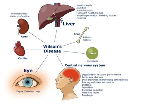 Wilson's disease - A rare disorder of copper metabolism