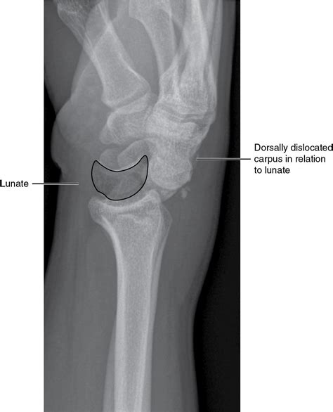 Image result for Lunate Dislocation Reduction