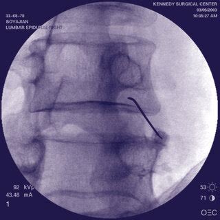 Image result for Lumbar Discogram