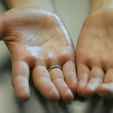 Sweaty Palms/Underarms | Hyperhidrosis Treatment Singapore