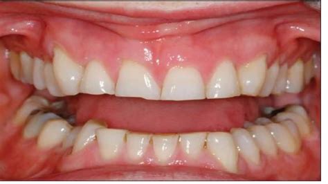ATTRITION OF TEETH (Regressive Alterations of Teeth) | PPTX
