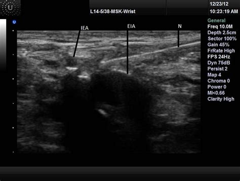 New Approach of Ultrasound-Guided Genitofemoral Nerve Block in Addition ...