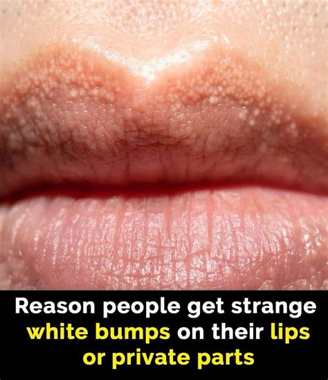 What Are Those White Bumps That Can Appear On Your Private Parts and What Causes Them? - Everything