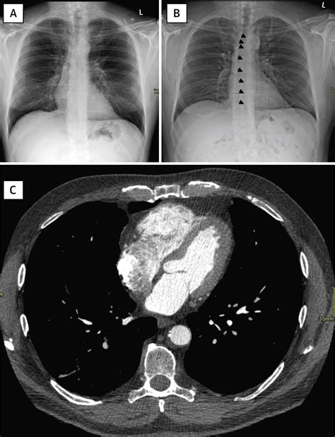 Boot-Shaped Heart After Robotic Coronary Assist Bypass Surgery | JACC ...