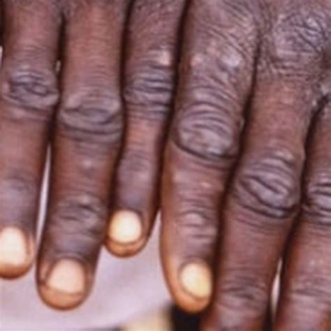 WHO fordert Millionen für Kampf gegen Mpox - - Universimed - Medizin im ...