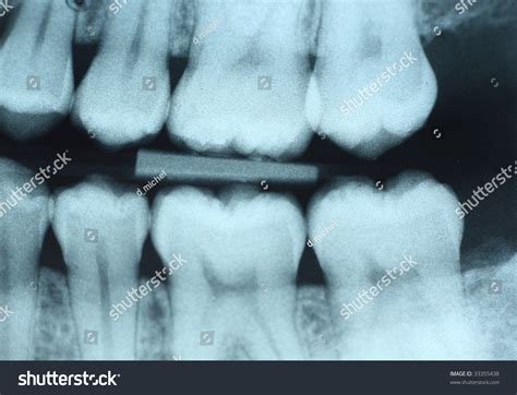 What Is Bitewing X Ray at Lyle Bowers blog