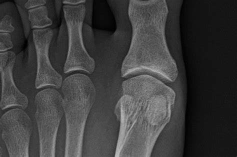 OrthoDx: Sesamoid Fracture - Clinical Advisor