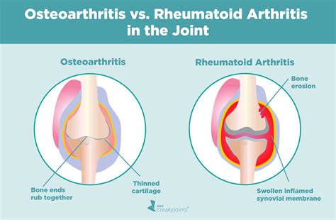 Rheumatoid Arthritis Disease Rheumatoid Arthritis And Osteoarthritis: