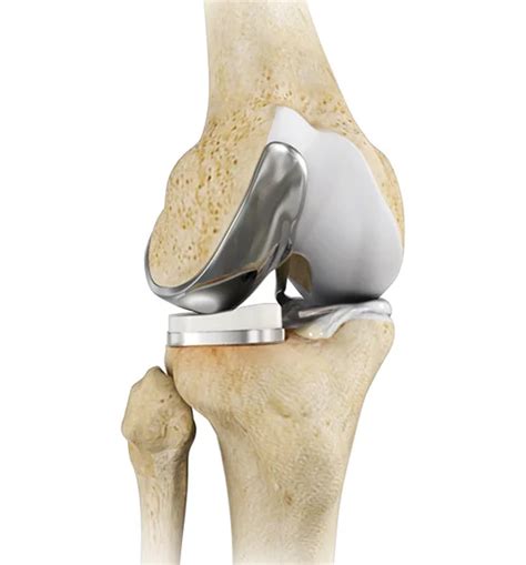 Robotic Partial Knee Replacement Surgery by Best Orthopedic Surgeon
