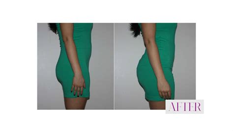 Brazilian Butt Lift Surgery in Abu Dhabi | Buttock Lift in UAE