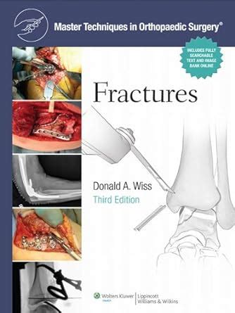 Master Techniques in Orthopaedic Surgery: Fractures eBook : Wiss ...