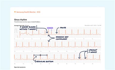 Ectopic Atrial Rhythm Vs. Premature Atrial Contraction (Couplet) on Your Watch ECG | Qaly