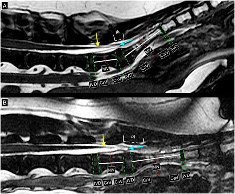 Frontiers | Occult tethered cord syndrome: insights into clinical and ...