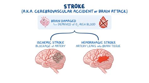 Hemorrhagic stroke - Intracranial hemorrhage (ICH) and subarachnoid ...