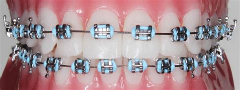 Image result for braces