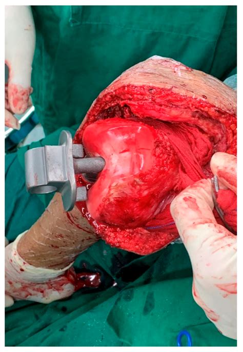 A Custom Hinged Endoprosthesis for the Treatment of Proximal Tibial ...
