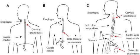 Advances in Esophageal Reconstruction After Cancer Surgery