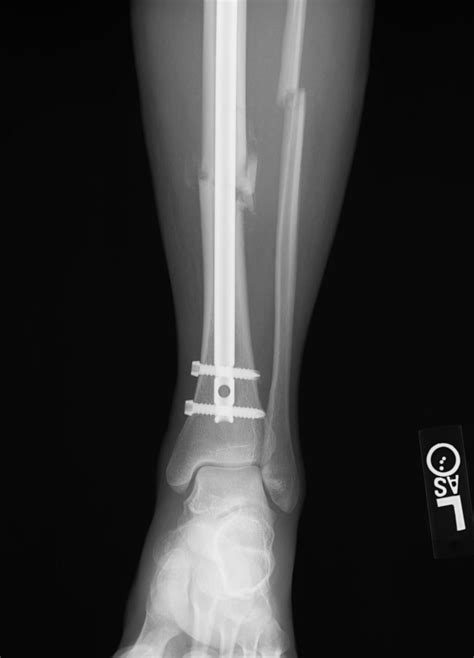 Why does mid shaft tib-fib fracture (tib ORIF) cause limited dorsiflexion? : r/Orthopedics