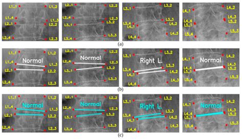 BUU-LSPINE: A Thai Open Lumbar Spine Dataset for Spondylolisthesis ...