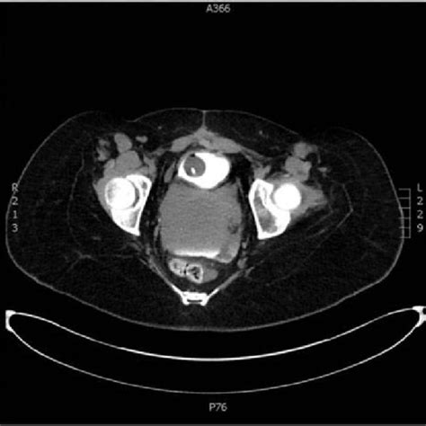 Image result for Cystogram Procedure for CT Scan