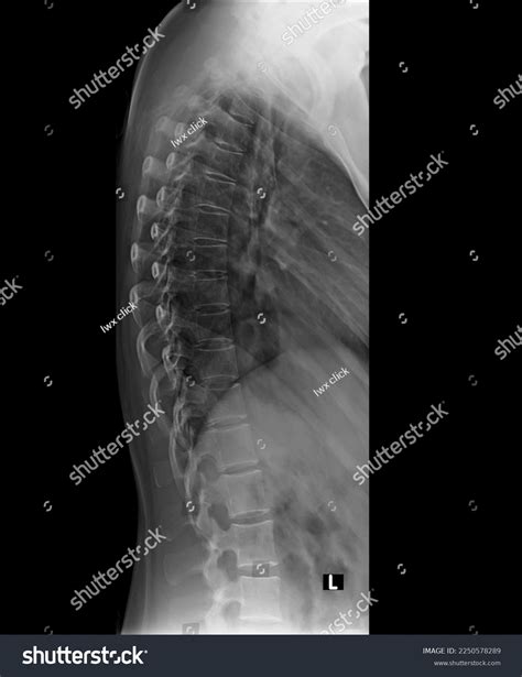 Thoracic Spine Xray