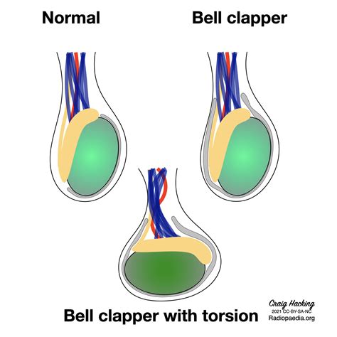 Bell Clapper Deformity