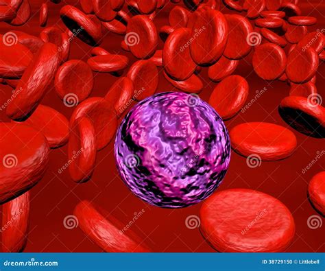 Leucemia mieloide aguda stock de ilustración. Ilustración de bacterias ...